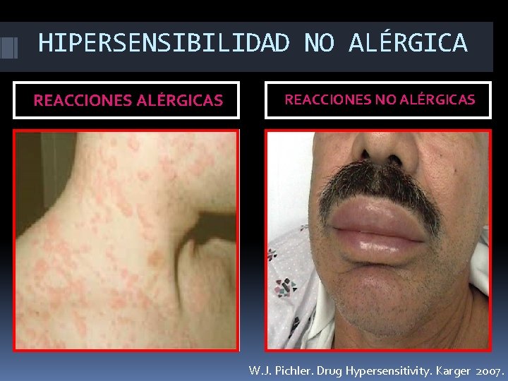 HIPERSENSIBILIDAD NO ALÉRGICA REACCIONES ALÉRGICAS Antibióticos Betalactámicos: Penicilinas. Cefalosporinas. Anestésicos Locales. AINES : Pirazolonas.