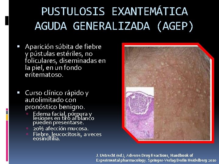 PUSTULOSIS EXANTEMÁTICA AGUDA GENERALIZADA (AGEP) Aparición súbita de fiebre y pústulas estériles, no foliculares,