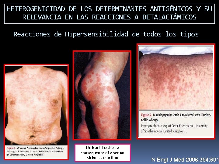 HETEROGENICIDAD DE LOS DETERMINANTES ANTIGÉNICOS Y SU RELEVANCIA EN LAS REACCIONES A BETALACTÁMICOS Reacciones