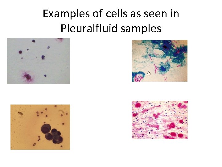 Examples of cells as seen in Pleuralfluid samples 