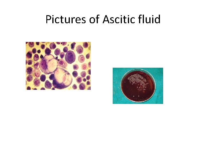 Pictures of Ascitic fluid 