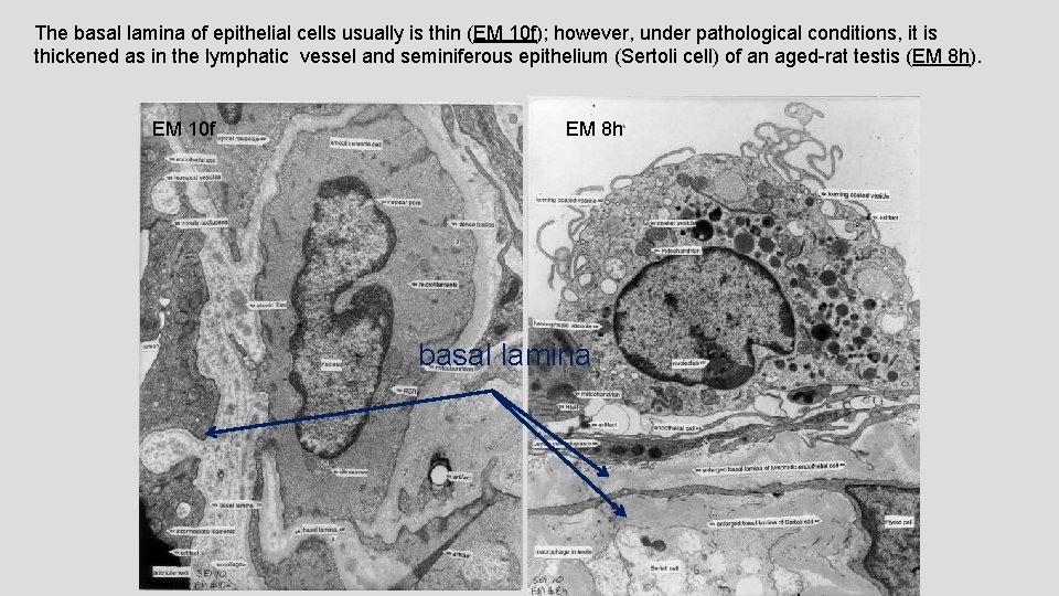 The basal lamina of epithelial cells usually is thin (EM 10 f); however, under