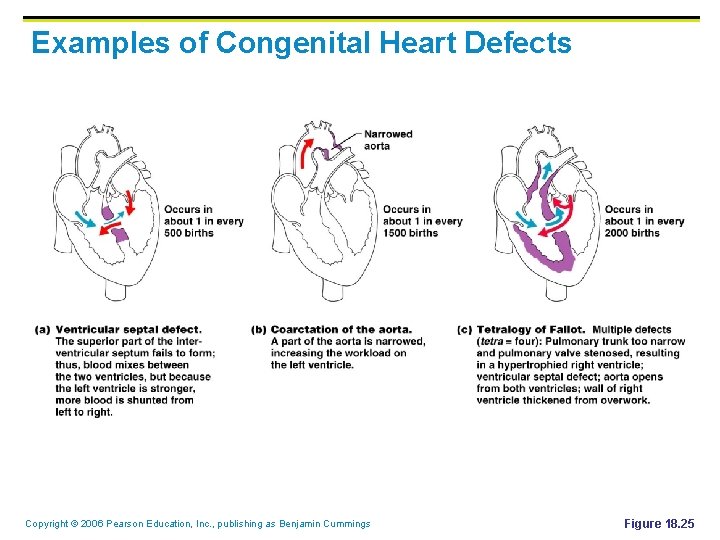 Examples of Congenital Heart Defects Copyright © 2006 Pearson Education, Inc. , publishing as