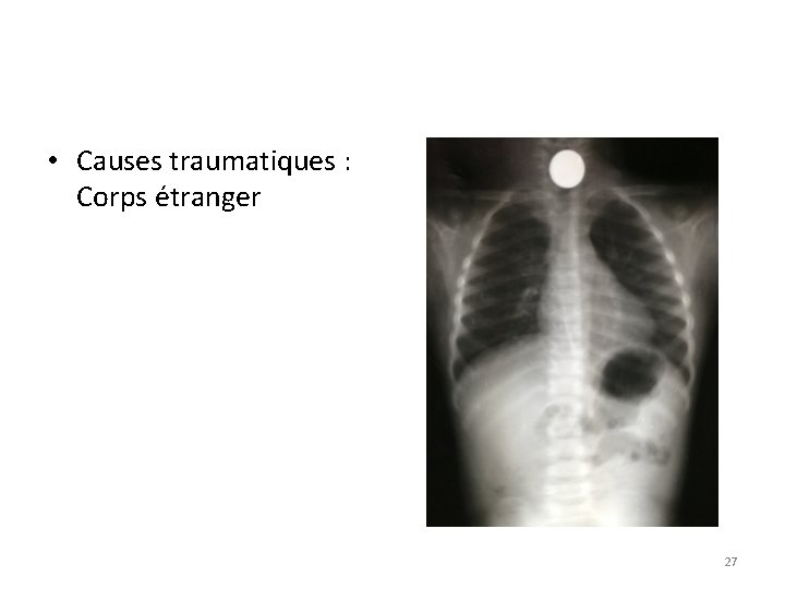  • Causes traumatiques : Corps étranger 27 