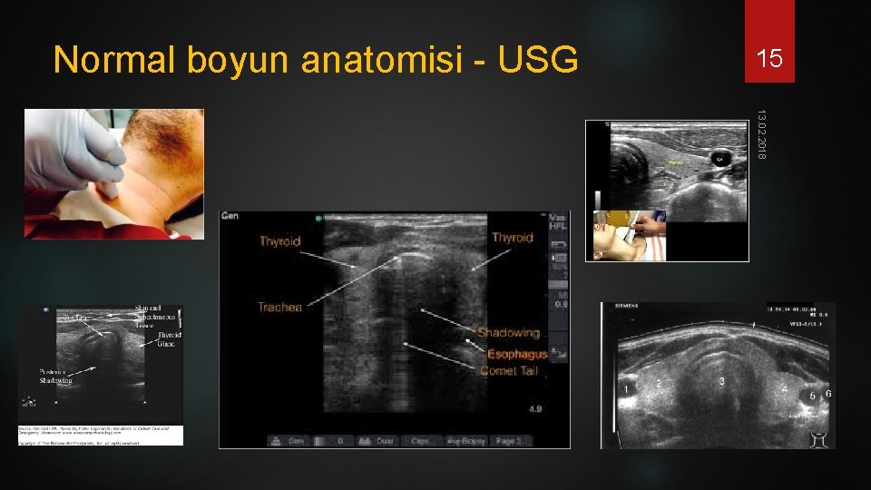 Normal boyun anatomisi - USG 15 13. 02. 2018 