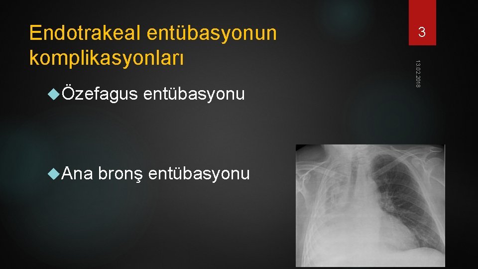  Özefagus entübasyonu Ana bronş entübasyonu 3 13. 02. 2018 Endotrakeal entübasyonun komplikasyonları 