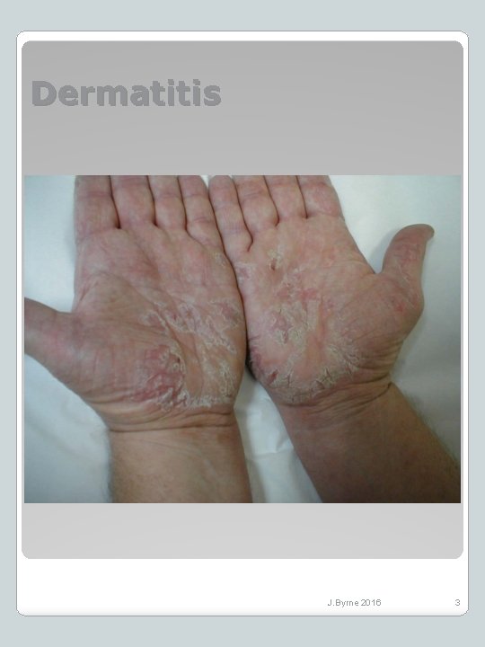 Dermatitis J. Byrne 2016 3 