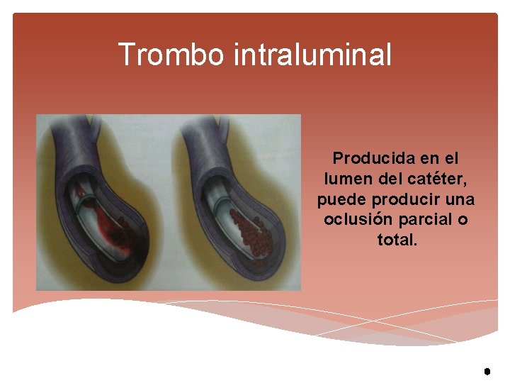 Trombo intraluminal Producida en el lumen del catéter, puede producir una oclusión parcial o