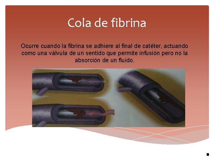 Cola de fibrina Ocurre cuando la fibrina se adhiere al final de catéter, actuando