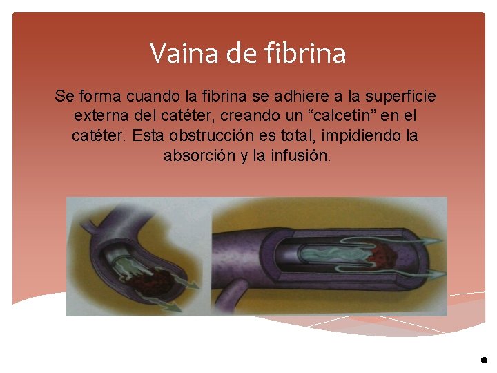 Vaina de fibrina Se forma cuando la fibrina se adhiere a la superficie externa