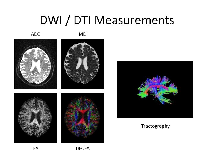 DWI / DTI Measurements ADC MD Tractography FA DECFA 