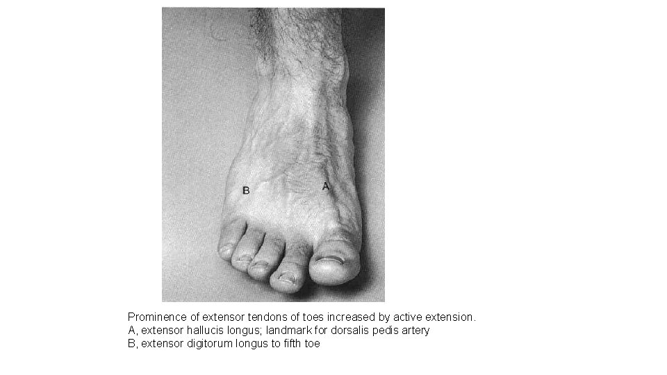 Prominence of extensor tendons of toes increased by active extension. A, extensor hallucis longus;