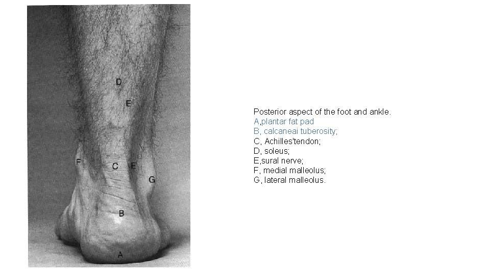 Posterior aspect of the foot and ankle. A, plantar fat pad B, calcaneai tuberosity;