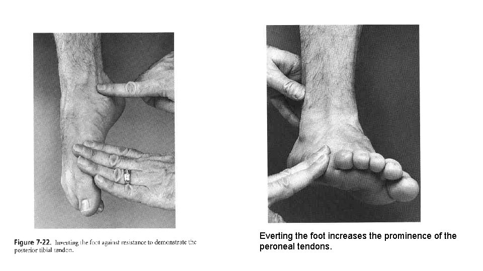 Everting the foot increases the prominence of the peroneal tendons. 
