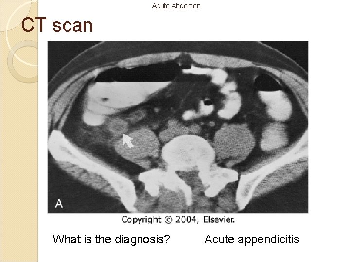 Acute Abdomen CT scan What is the diagnosis? Acute appendicitis 