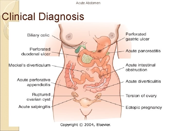 Acute Abdomen Clinical Diagnosis 