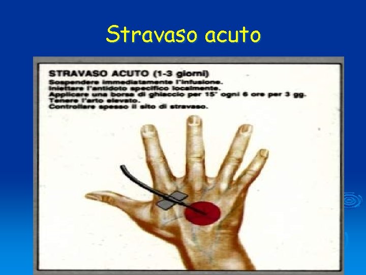 Stravaso acuto 