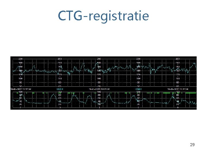 CTG-registratie 29 