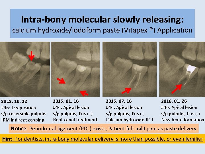 Intra-bony molecular slowly releasing: calcium hydroxide/iodoform paste (Vitapex ®) Application 2012. 10. 22 #46: