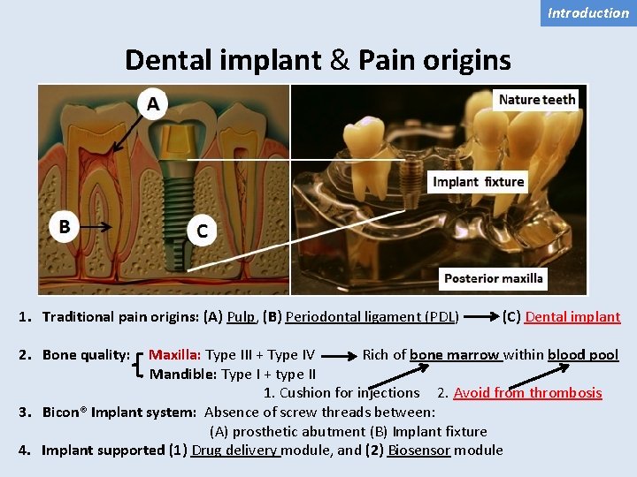 Introduction Dental implant & Pain origins 1. Traditional pain origins: (A) Pulp, (B) Periodontal