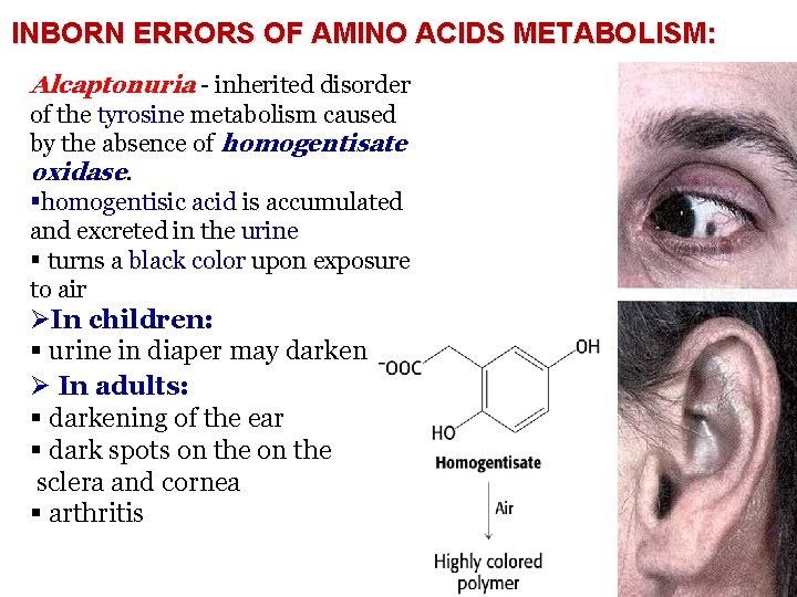 INBORN ERRORS OF AMINO ACIDS METABOLISM: Alcaptonuria - inherited disorder of the tyrosine metabolism