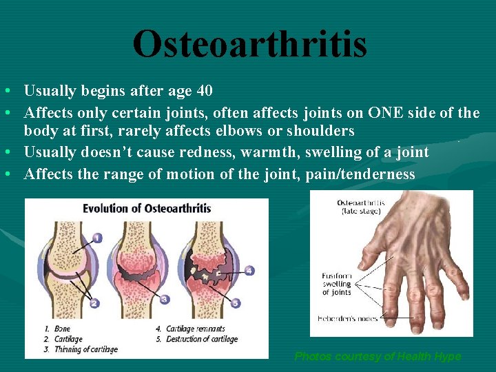 Osteoarthritis • Usually begins after age 40 • Affects only certain joints, often affects
