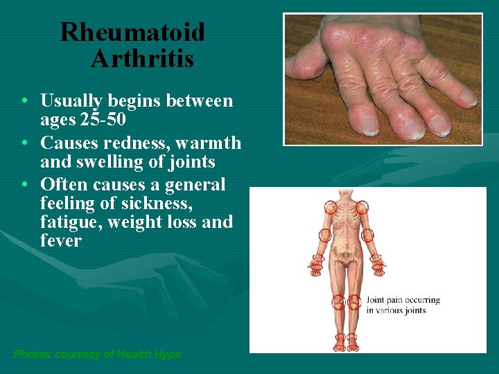 Rheumatoid Arthritis • Usually begins between ages 25 -50 • Causes redness, warmth and