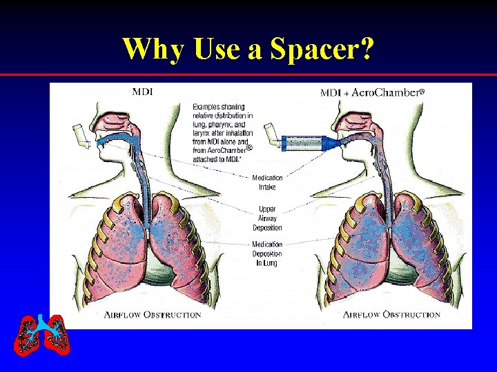 Why Use a Spacer? 