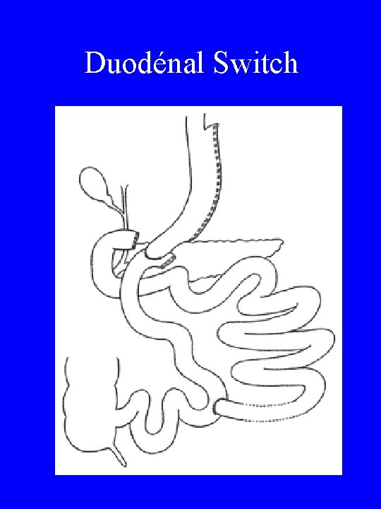 Duodénal Switch 