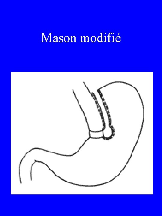 Mason modifié 