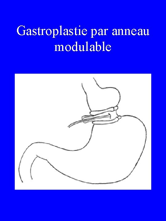 Gastroplastie par anneau modulable 