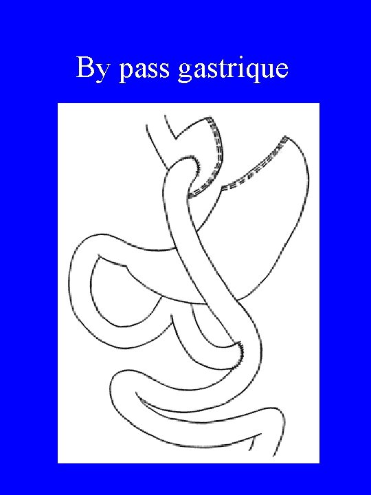 By pass gastrique 