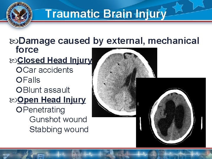 Traumatic Brain Injury Damage caused by external, mechanical force Closed Head Injury Car accidents Traumatic Brain Injury Damage caused by external, mechanical force Closed Head Injury Car accidents