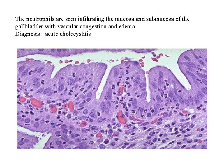 The neutrophils are seen infiltrating the mucosa and submucosa of the gallbladder with vascular