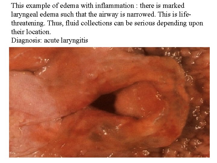 This example of edema with inflammation : there is marked laryngeal edema such that