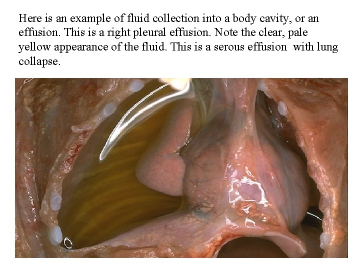Here is an example of fluid collection into a body cavity, or an effusion.