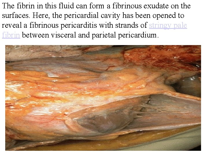 The fibrin in this fluid can form a fibrinous exudate on the surfaces. Here,