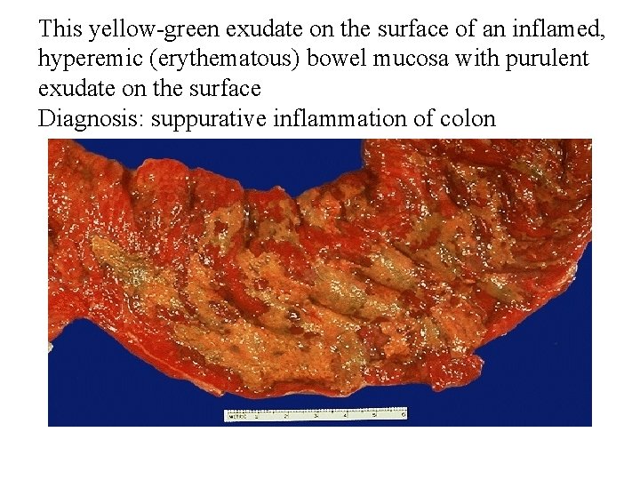 This yellow-green exudate on the surface of an inflamed, hyperemic (erythematous) bowel mucosa with