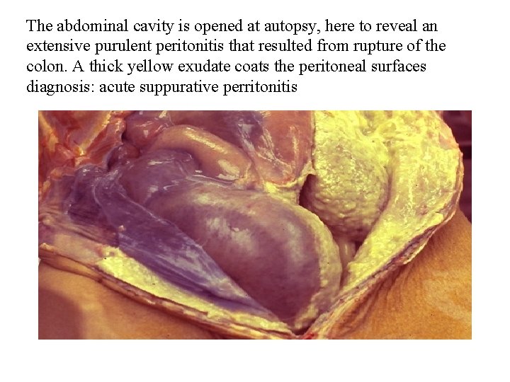The abdominal cavity is opened at autopsy, here to reveal an extensive purulent peritonitis