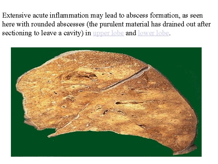 Extensive acute inflammation may lead to abscess formation, as seen here with rounded abscesses