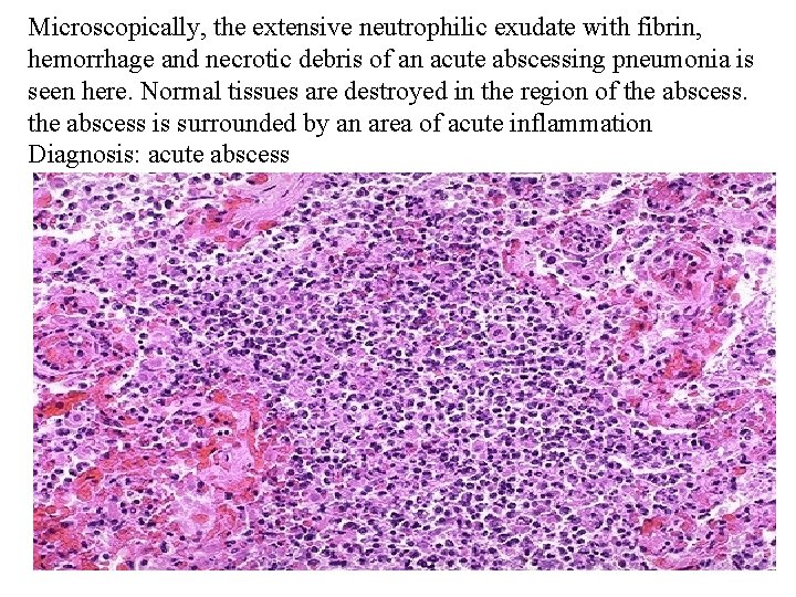 Microscopically, the extensive neutrophilic exudate with fibrin, hemorrhage and necrotic debris of an acute