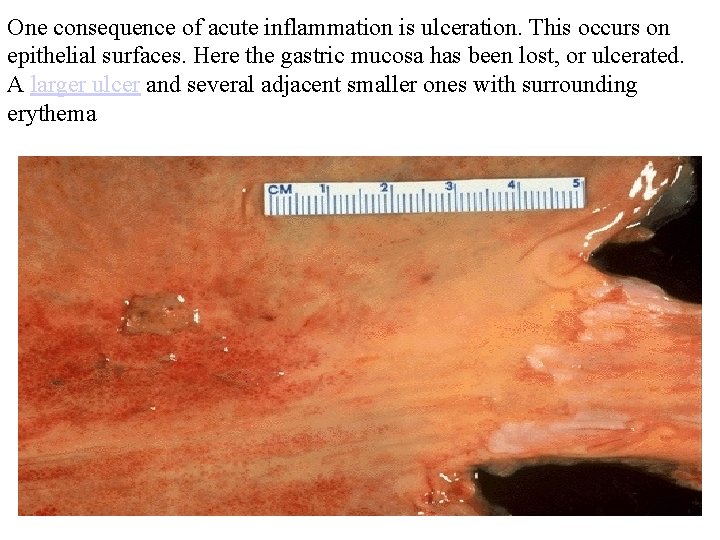 One consequence of acute inflammation is ulceration. This occurs on epithelial surfaces. Here the