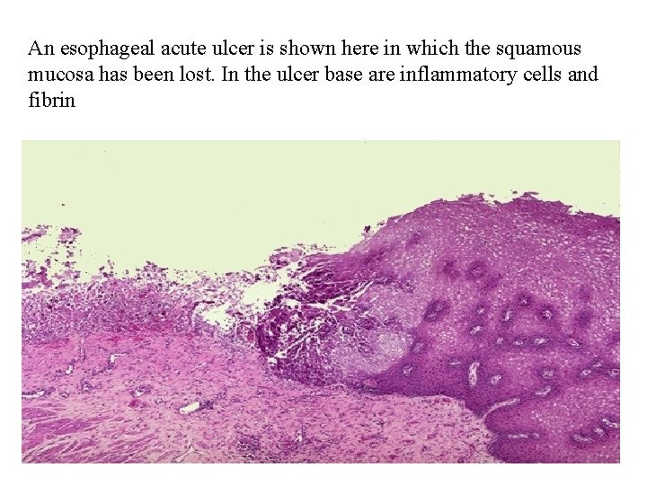 An esophageal acute ulcer is shown here in which the squamous mucosa has been