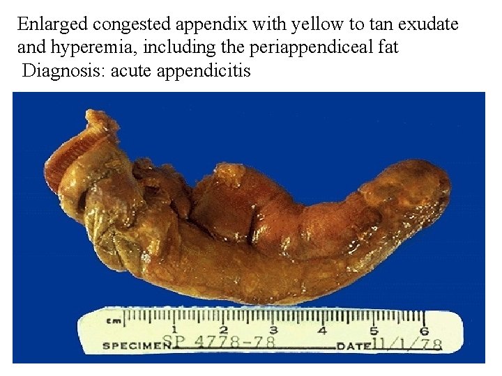 Enlarged congested appendix with yellow to tan exudate and hyperemia, including the periappendiceal fat