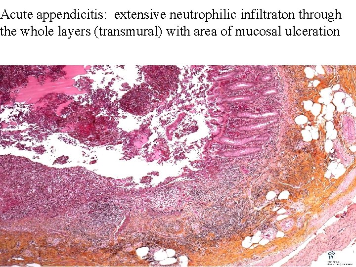 Acute appendicitis: extensive neutrophilic infiltraton through the whole layers (transmural) with area of mucosal