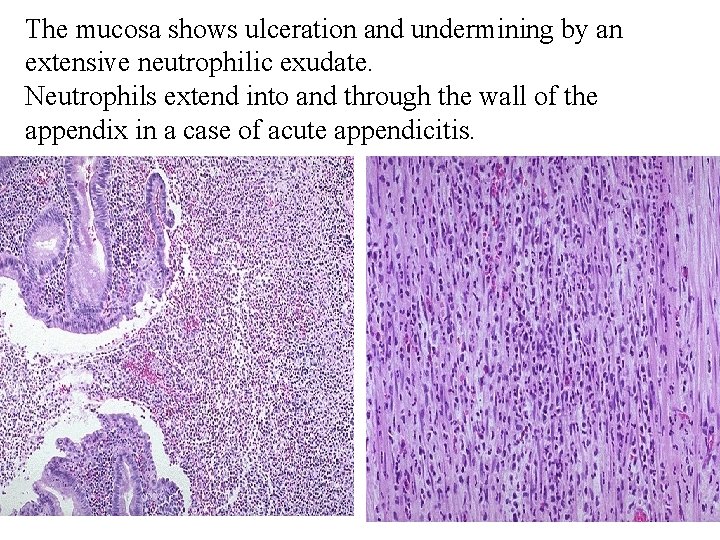 The mucosa shows ulceration and undermining by an extensive neutrophilic exudate. Neutrophils extend into