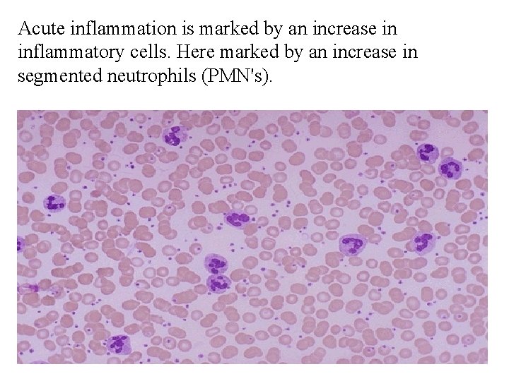 Acute inflammation is marked by an increase in inflammatory cells. Here marked by an