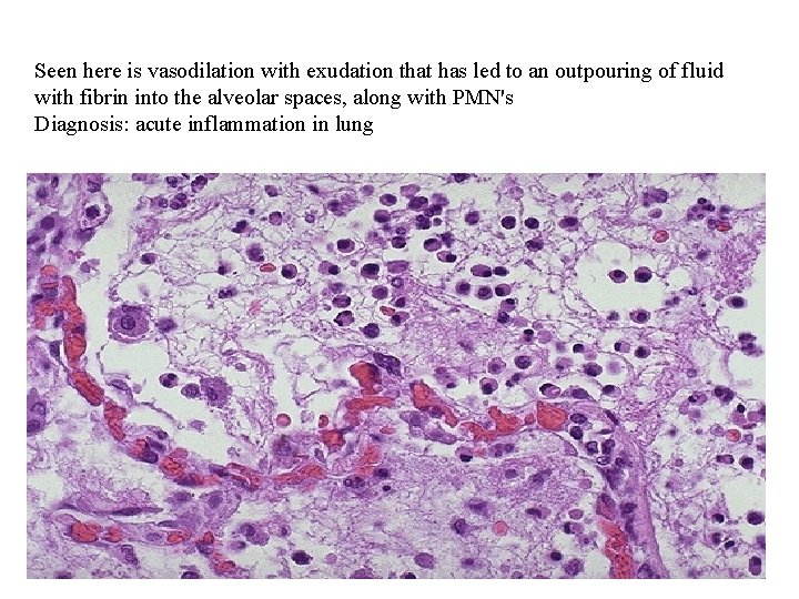 Seen here is vasodilation with exudation that has led to an outpouring of fluid