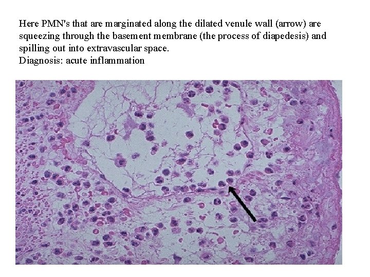 Here PMN's that are marginated along the dilated venule wall (arrow) are squeezing through
