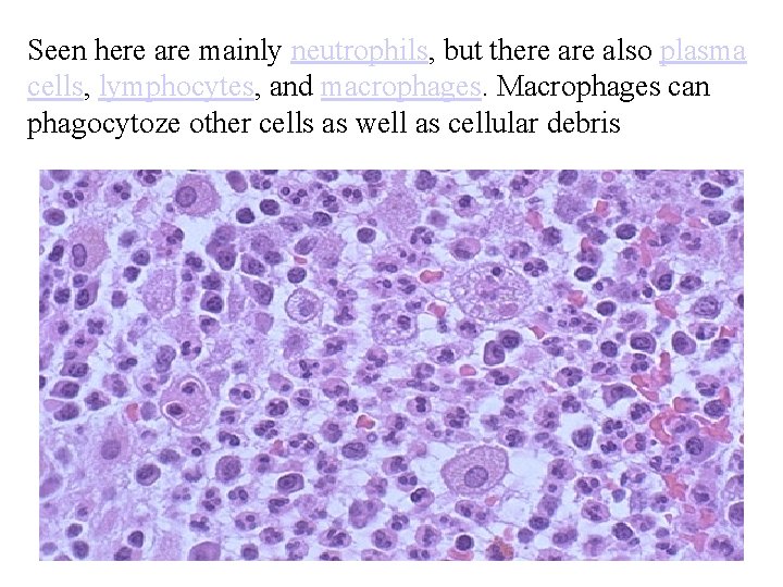 Seen here are mainly neutrophils, but there also plasma cells, lymphocytes, and macrophages. Macrophages